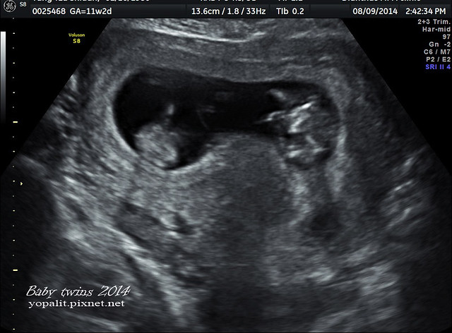 [孕] 18W超音波- 雙胞胎18週超音波數據 @ELSA菲常好攝