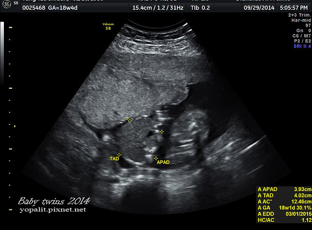 [孕] 18W超音波- 雙胞胎18週超音波數據 @ELSA菲常好攝