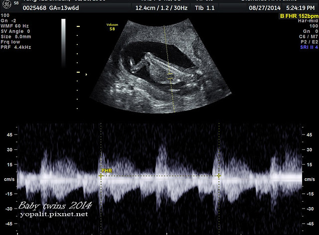 [孕] 13w 超音波、雙胞胎 懷孕三個月出血 @ELSA菲常好攝