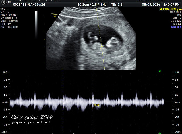 [孕] 11W產檢。超音波  雙胞胎超音波 胎兒大小|11週懷孕身體變化 @ELSA菲常好攝