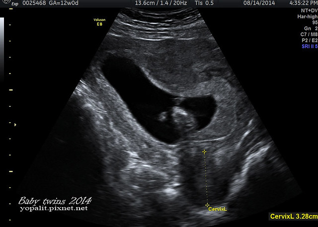 [孕] 12W 禾馨頸部透明帶+母血唐氏症篩檢|台北市民補助|自費產檢|早產風險評估 @ELSA菲常好攝