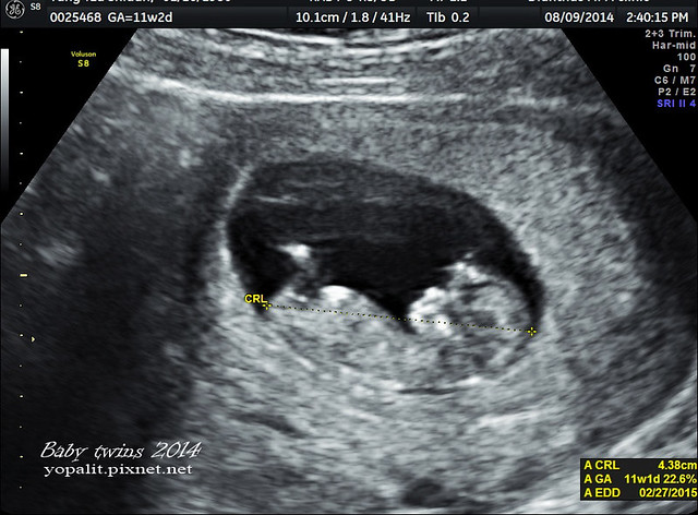 [孕] 雙胞胎 21週超音波 檢查|21w 高層次超音波 @ELSA菲常好攝