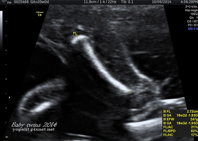 [孕] 20W 禾馨高層次超音波-雙胞胎高層次 @ELSA菲常好攝