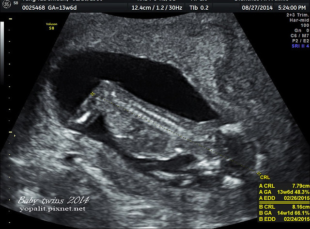 [孕] 13w 超音波、雙胞胎 懷孕三個月出血 @ELSA菲常好攝