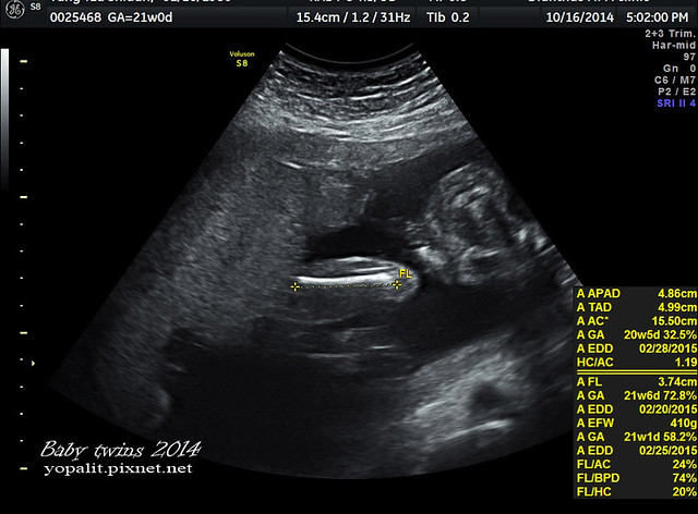 [孕] 雙胞胎 21週超音波 檢查|21w 高層次超音波 @ELSA菲常好攝