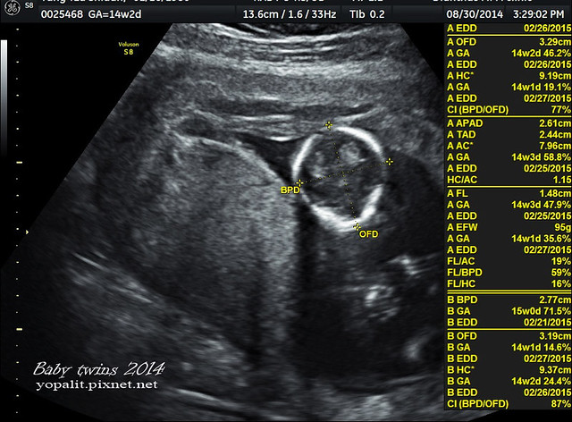 [孕] 14W超音波-雙胞胎超音波|自費產檢|禾馨婦產科收費 @ELSA菲常好攝